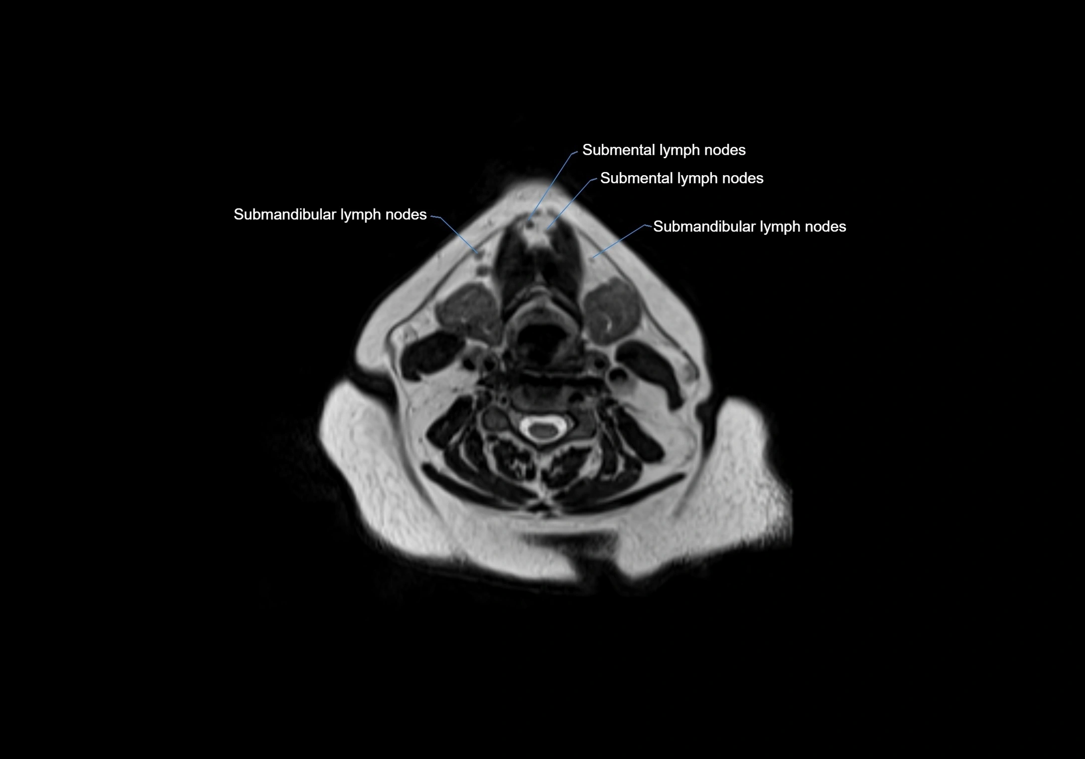 Neck axial  lymph node cross sectional MRI anatomy 3T MRI  image-img-00001-00057.webp